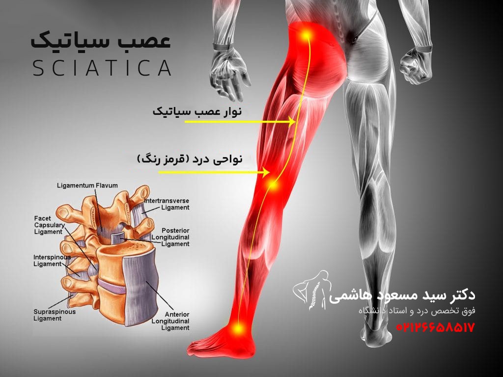 درمان درد عصب سیاتیک