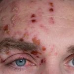 تزریق واکسن زونا توسط فوق تخصص درد: اهمیت، روش و مزایا